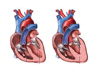 heart-with-HCM